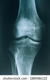 X-ray of the knee joint. Knee bone injury