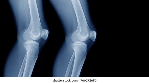 Xray Knee Joint Both Side Lateral Stock Photo 766292698 