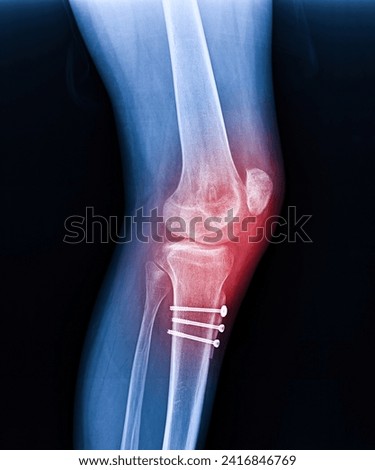 X-ray Knee Joint Fracture proximal tibia and Post fix fracture proximal tibia with plate and screws, highlighted in red
