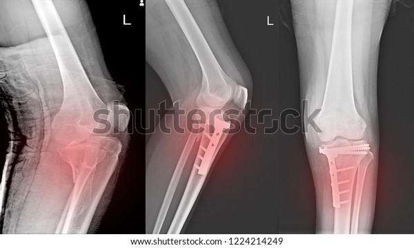 Xray Knee Joint Fracture Proximal Tibia Stock Photo (Edit Now) 1224214249