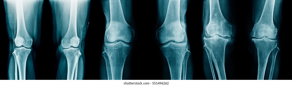 x-ray knee joint show degenerative change of knee joint collection