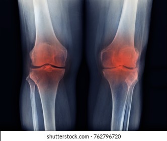 Xray Knee Joint Show Osteoarthritis