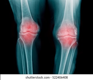 x-ray knee joint show severe osteoarthritis both knee 