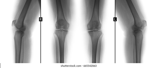 X-ray of the knee joints. Deforming arthrosis. Myositis. Negative.