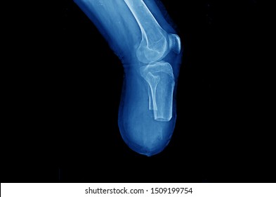 x-ray of knee showing bone stump after below knee or BK amputation. The patient has giant cell tumor at distal part of tibia and need surgery. The patient need leg prosthesis after the operation.