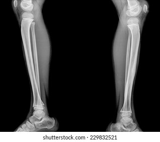 X Ray Leg Tibia Infection Tibia Stock Photo 599360057 | Shutterstock