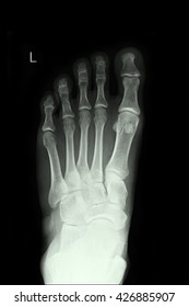 Xray Left Foot