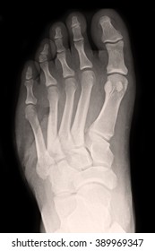 Ap Foot Xray Images Stock Photos Vectors Shutterstock