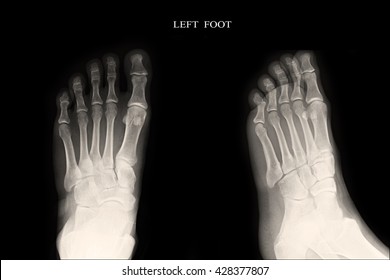 Xray Left Foot Aplateral Stock Photo (Edit Now) 428377822