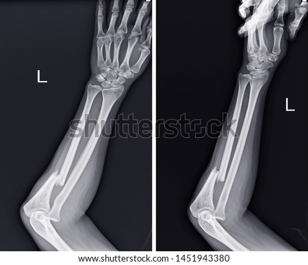 X-ray Left forearm( AP Lat) Fracture proximal Left ulna and soft tissue swelling,medical image concept.