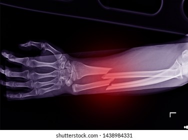 3,190 Forearm X Ray Stock Photos, Images & Photography 