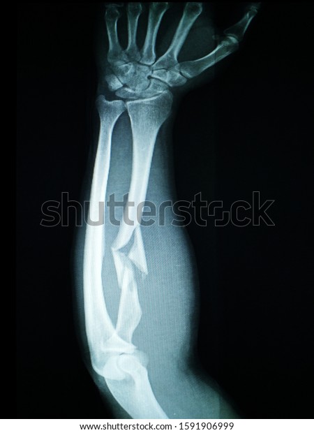 Xray Left Forearm Fracture Proximal Left Stock Photo 1591906999 ...