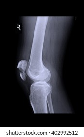 Dorso Palmar View Xray Showing Severely Stock Photo (Edit Now) 1739821541