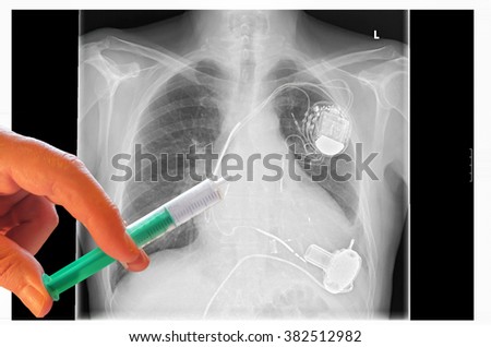X-ray left side of the chest. Heart with implanted pacemaker system. Below are the pump of the heart assist system. Hand with syringe in the image.