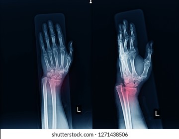 Xray Left Wrist Joint Aplateral Human Stock Photo 1271438506 | Shutterstock