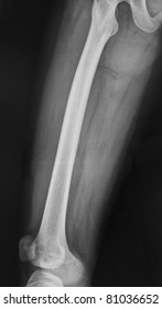 x-ray of leg