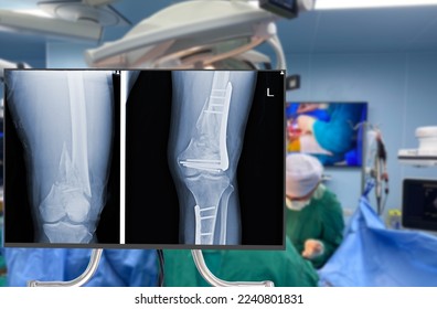 x-ray of leg and knee. Blurry Traumatology orthopedic surgery hospital emergency operating room for the leg broken operation. Medical health and Education concept. 