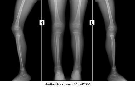 X-ray Of The Lower Limbs. Normal Child Bone. 