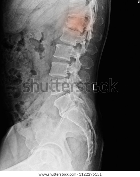 Xray Ls Spine Collapsed Fracture L1 Stock Photo (Edit Now) 1122295151