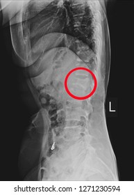 X-ray L-S Spine LATERAL: Finding Moderate Compression Fracture Of L1 Vertebra And Lumbar Spondylosis.