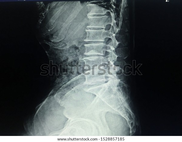 Xray Ls Spine Scoliosis Loss Lordosis Stock Photo 1528857185 | Shutterstock