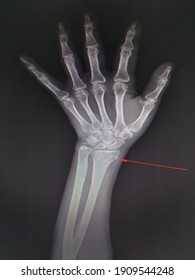 X-ray Lt. Wrist AP finding Non displaced fracture at distal epi-metaphyses of left radius.Avulsion fracture at tip of left ulnar styloid process.No definite joint subluxation.Medical image concept.