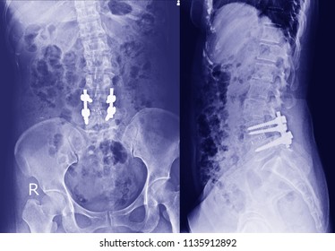 Xray Pelvis Spinal Column Side View Stock Photo (edit Now) 1136557826