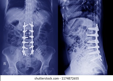 X-ray Lumbar Spine AP,Lateral : A Human And Postoperative Treatment For Degenerative Lumbar Disc Disease By Decompression And Fix By Iron Rod And Screws.Blue Tone.