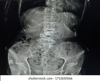 X-ray Lumbo-sacral Spine Finding:lumbar Spondylosis With Mild Scoliosis Of Lumbar Spine,Mild Compression Fracture Of L4 Vertebra,Medical Image Concept.