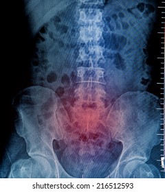 Xray Lumbosacral Spine Pelvis Stock Photo 216512593 