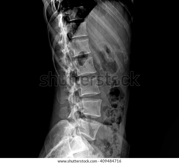 Xray Lumbosacral Spine Pelvis Stock Photo (edit Now) 409484716