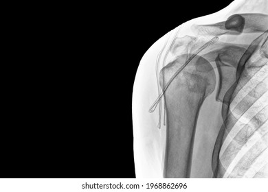 X-ray Of A Luminous Of Shoulder Isolated On Black Background. Chronic Dislocation Of The Long Biceps Tendon After Surgery. SSC Tendon Corkscrew Anchor. Inverted Image