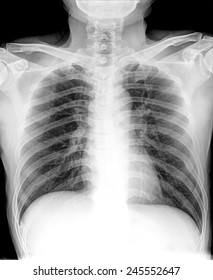 Xray Lung Cancer Pleural Effusion Stock Photo 245552647 | Shutterstock