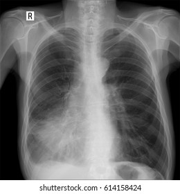 Xray Lung Showing Large Infiltrate Middle Stock Photo 614158424 ...