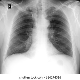 Chest X Ray Showing Coin Neckcorpus Stock Photo 1946975740 | Shutterstock