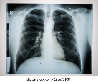 X-ray Of A Lung. Upper Body Of A Man