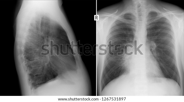 59 Bronchopneumonia Images, Stock Photos & Vectors 