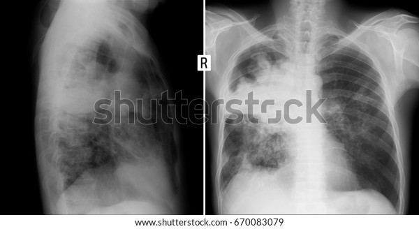 Xray Lungs Cirrhotic Tuberculosis Lungs Stock Photo (Edit Now) 670083079