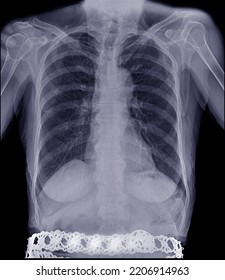 
X-ray Of The Lungs In Elderly Women With Pneumonia, Emphysema, Lung, Diagnosis