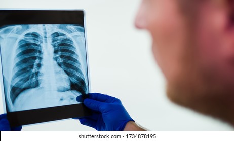 X-ray Of The Lungs In The Hands Of A Doctor.Doctor Looking At An X-ray In The Surgical Room.Diagnose Pneumonia,pulmonary Edema In A Photo Picture.Study X-ray.