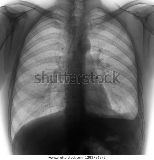 Xray Lungs Hemothorax Rib Fractures Left Stock Photo (Edit Now) 1283756878