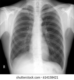 x-ray lungs: lobectomy right lung post tuberculosis