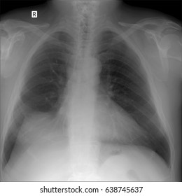 Lung Xray Stock Photo 1296442 | Shutterstock