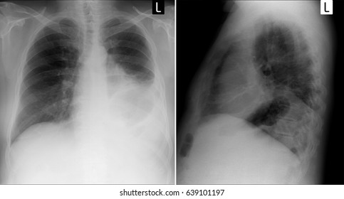 x-ray lungs: Lobectomy of the upper lobe of the left lung post cancer. 