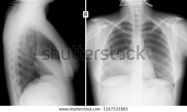 Xray Lungs Pleurisy Right Stock Photo (Edit Now) 1267531885