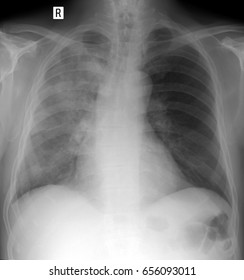 Xray Lungs Fibrotic Changes Stock Photo 656133661 | Shutterstock