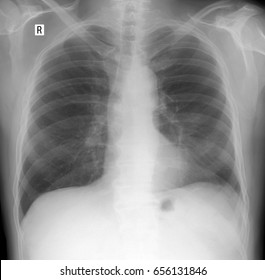 Xray Lungs Postoperative Lung Changes Stock Photo 656131846 | Shutterstock