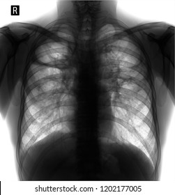 Xray Lungs Pulmonary Fibrosis Post Tuberculosis Stock Photo 1202177005 ...