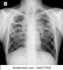 X-ray Lungs. Pulmonary Fibrosis. Post Tuberculosis.