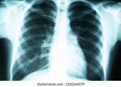 Xray Lungs Radiological Examination Chest Diseases Stock Photo 